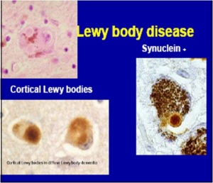 Lewy body
